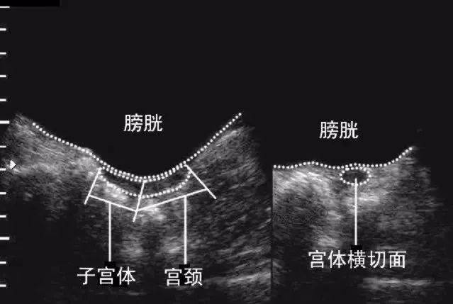 子宫横切面示意图图片