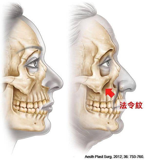 眼瞼臉頰交界拉長,伴隨韌帶鬆弛和中臉的軟組織流失,形成淚溝和眼袋.