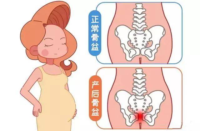 分娩後出現這種情況警惕恥骨聯合分離症,一誤悔終生