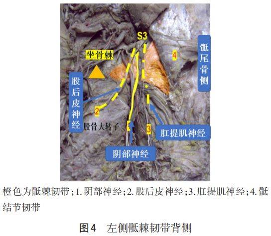 骶棘韧带区域解剖和三维重建研究