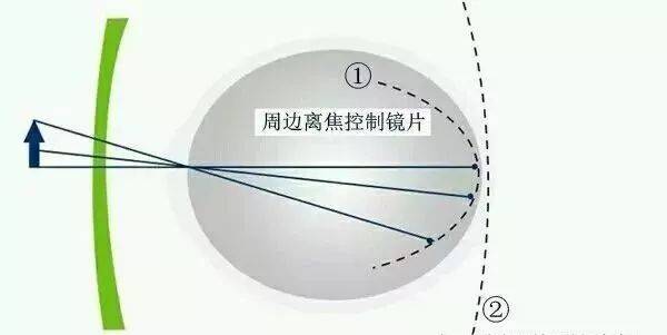 青少年近视周边离焦镜片你了解吗