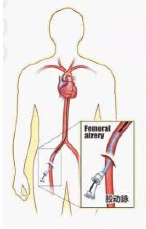 医生通过冠状动脉造影来观察患者心脏中的动脉,能看见动脉中是否有