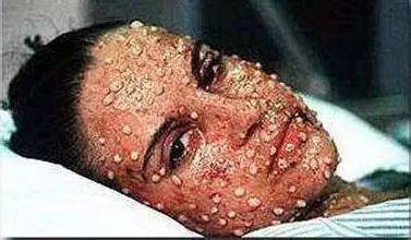 天花2. 脊髓灰质炎(俗称"小儿麻痹症")3. 丝虫病4.