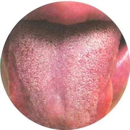 舌象上做辨别大部分肝火旺,体内湿热的人, 舌苔偏黄腻的迹象