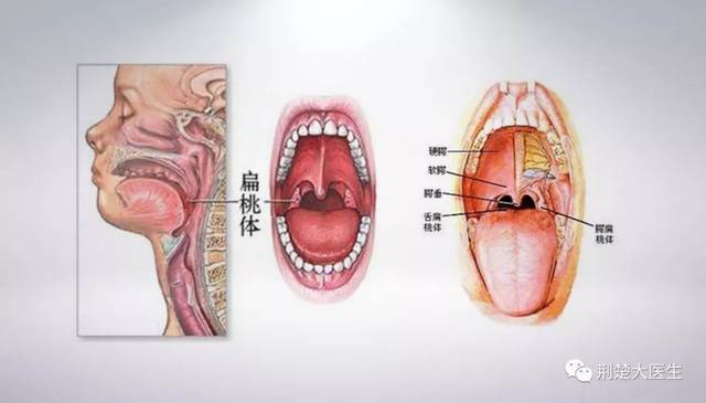 扁桃体假膜图片