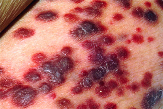 皮肤寄生虫感染 人体图片
