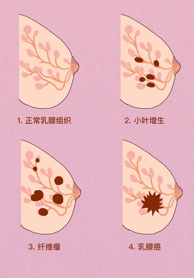 乳腺7点处的位置图图片