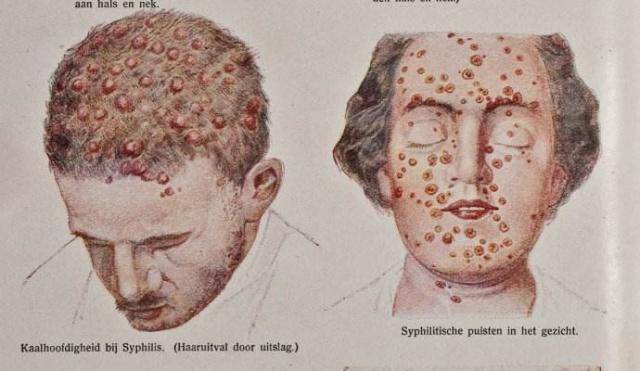 梅毒再次出现?无论男女,一旦皮肤出现这种现象,务必去做个检查