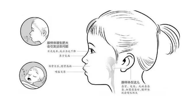 腺樣體面容