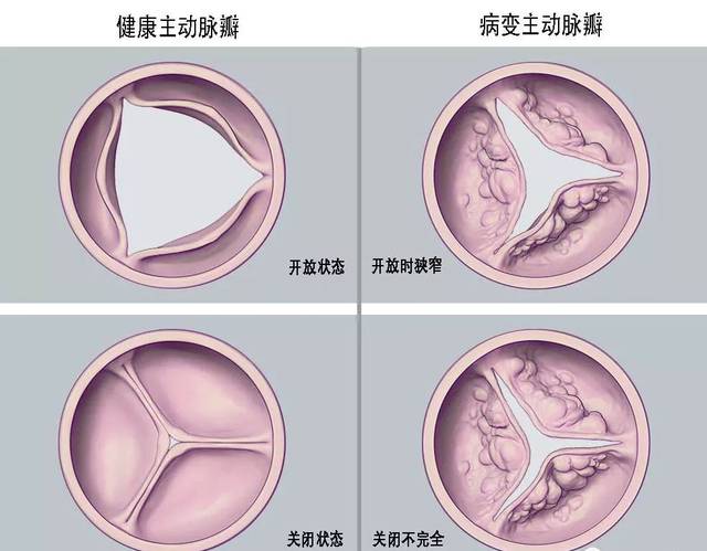 金属心脏瓣膜图片图片