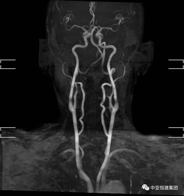 mra无创血管检查_手机搜狐网