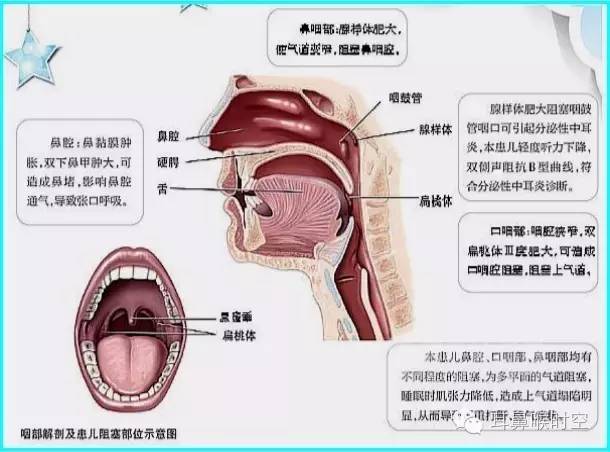 咽侧索增生图片