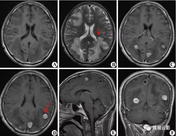 经典总结—颅脑疾病mr诊断