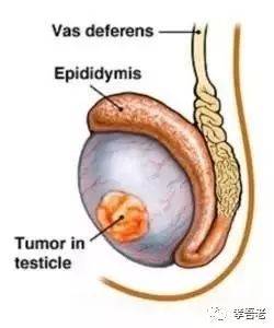 男人阴囊正常肿胀图片