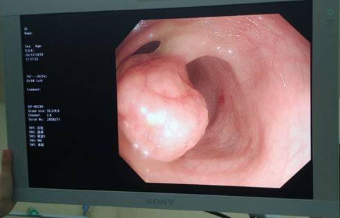 肠镜下发现的巨大息肉