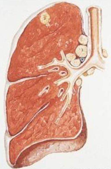 结核瘤vs周围型肺癌