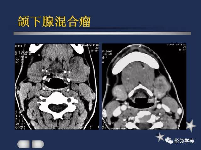 腮腺,颈部疾病影像诊断