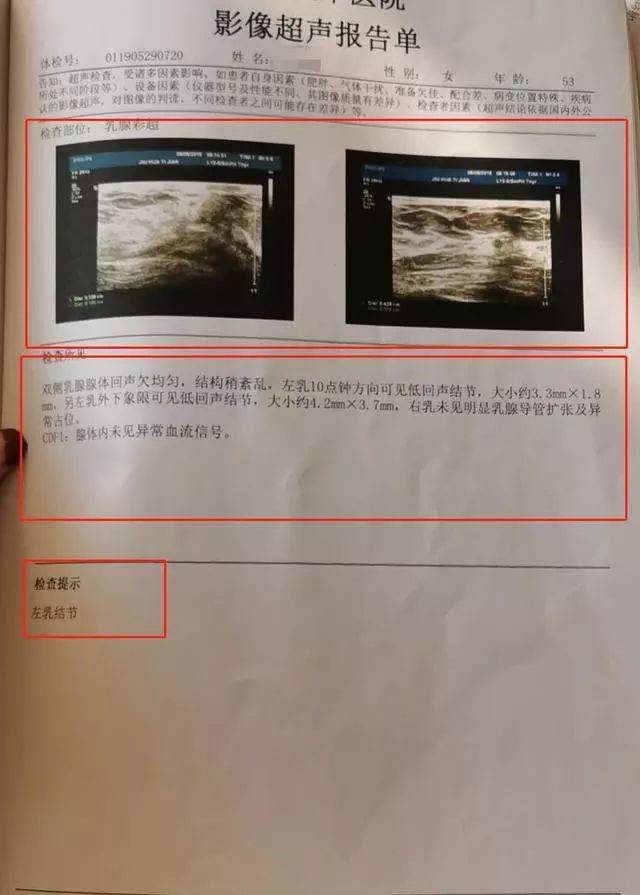 儿童乳腺发育彩超报告图片