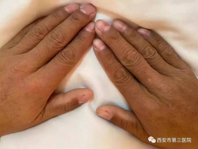 佩罗尼氏病 搜狐网
