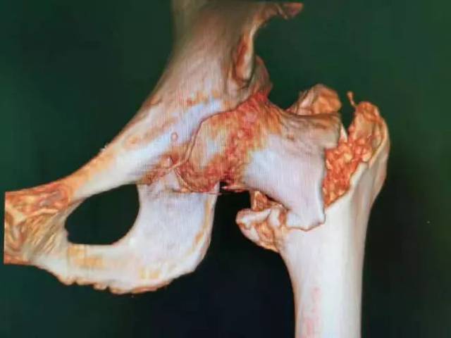 95岁老人摔断腿,疼痛难忍,这可急坏了他的家人!