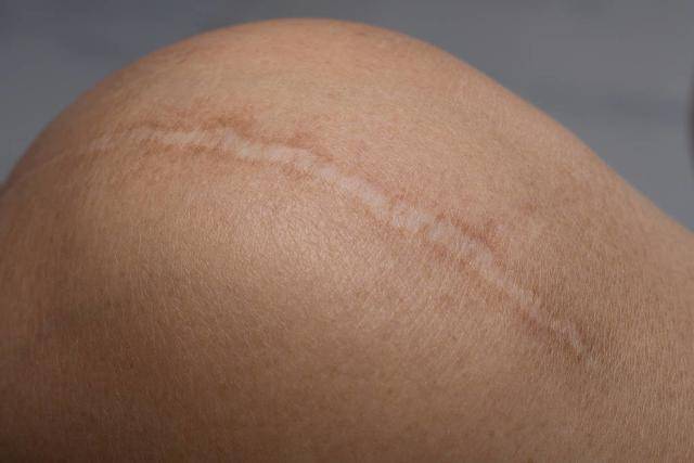 胥肖琴医生讲解疤痕增生期过后疤痕会变平吗