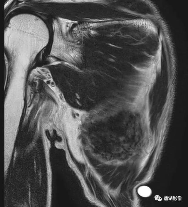精彩推荐背部弹力纤维瘤超典型影像表现