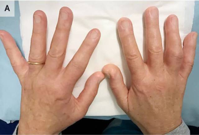 病例分享局限性硬皮病出现的指尖钙质沉着