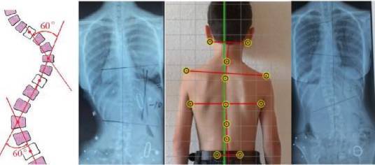 假期免费为您的孩子进行脊柱侧弯体格筛查!