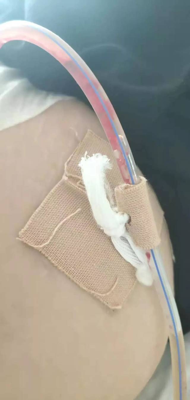 比"高举平台法"更有优势的引流管固定法,值得推广!