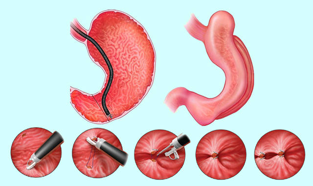 由袖狀胃縮胃手術改進升級而來,是通過胃鏡經口入胃部以吻合器將兩邊