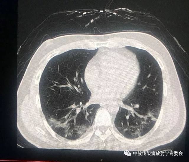 新冠肺炎肺部照片图片