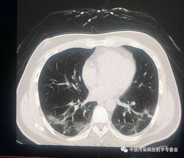 新冠肺炎肺部图片图片