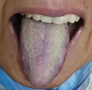 舌质淡紫,苔白腻,辨为寒性