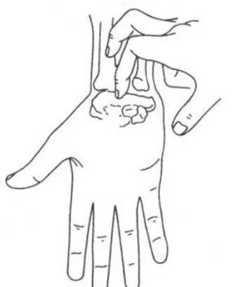 2,神经叩击实验(tinel征)阳性.