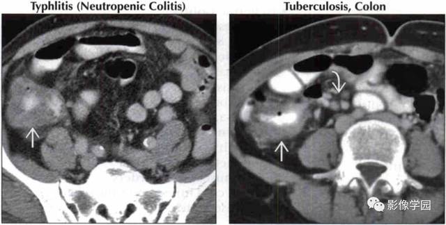 [疾病谱] 回盲部占位或炎症的影像鉴别诊断