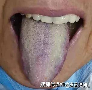 幽门螺旋杆菌舌头图片图片