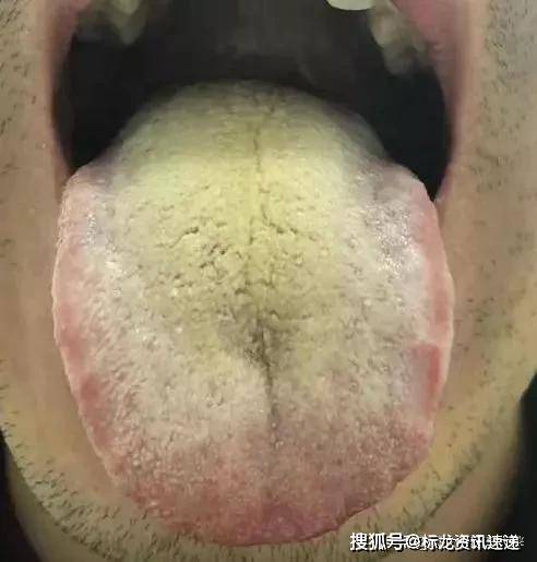 肠胃湿热舌头图片图片