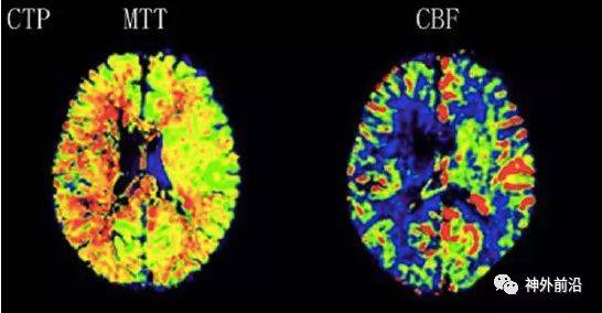 神经影像| 发现术后高灌注区 asl技术在烟雾病手术中应用进展