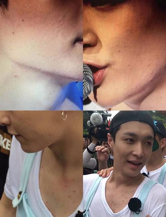 张艺兴皮肤差被群嘲八年,痘痘到底怎么搞?_手机搜狐网