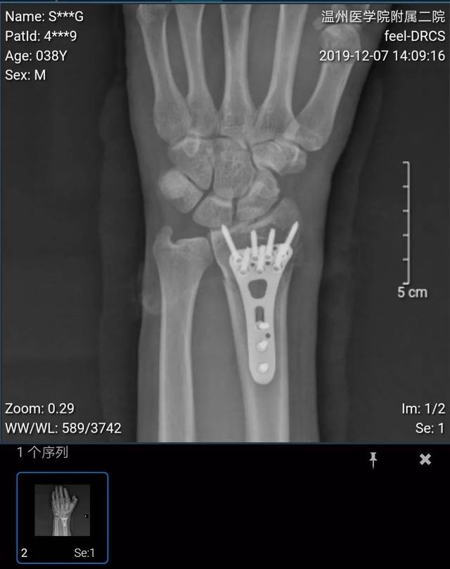 植入手臂的钢板和钢钉