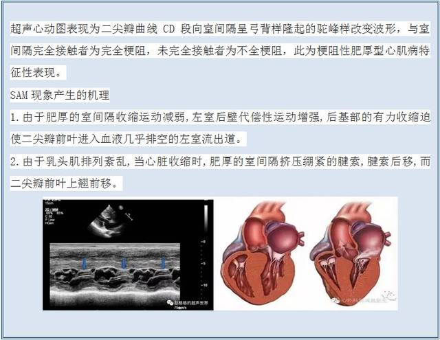 二尖瓣sam征图详解图片