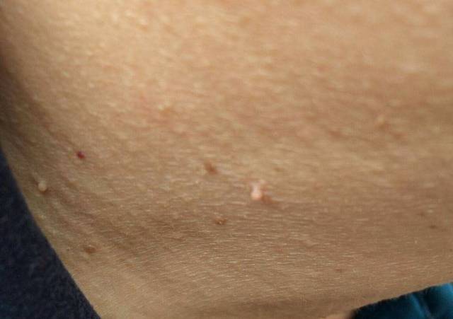 皮肤软纤维瘤图片早期图片