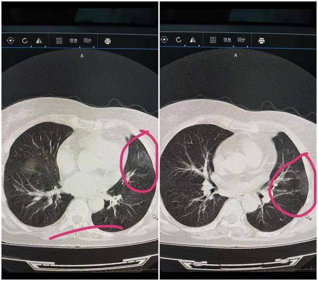 新冠肺部片子图片