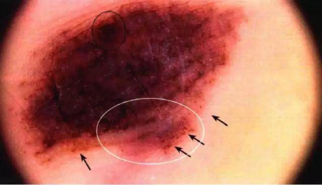 这样的痣易癌变,大人孩子都要警惕