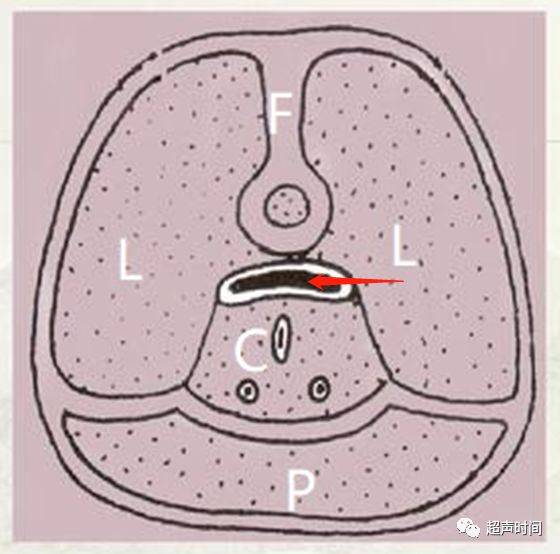 前列腺移行区图片