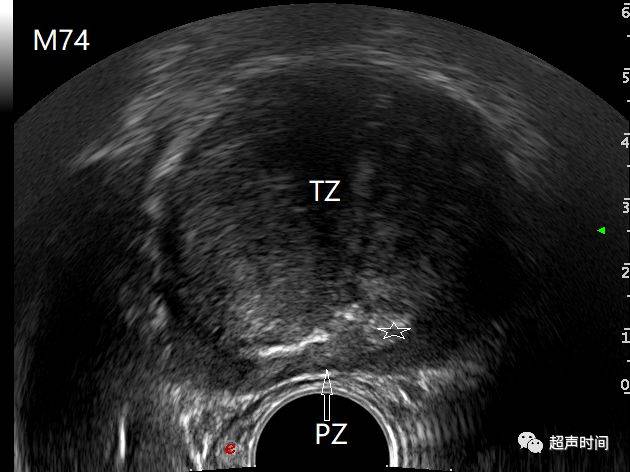 经直肠超声横切面示前列腺移行区(tz)明显增大,挤压外腺区(pz)