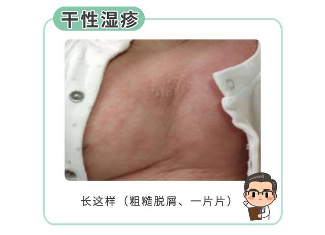 所有人,只要答对这4道题!可以搞定大多数小儿湿疹