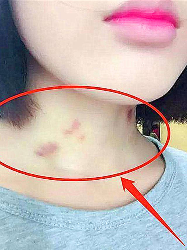 原创14岁女儿脖子上现"淤青",父母逼问下说出实情,女儿回答引深思