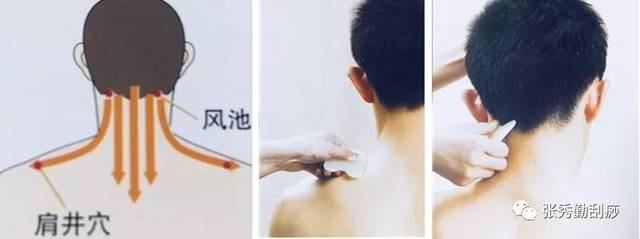 刮痧刮哪里去火示意图,刮痧去肝火的位置图片,刮痧去火位置图片_大山谷图库