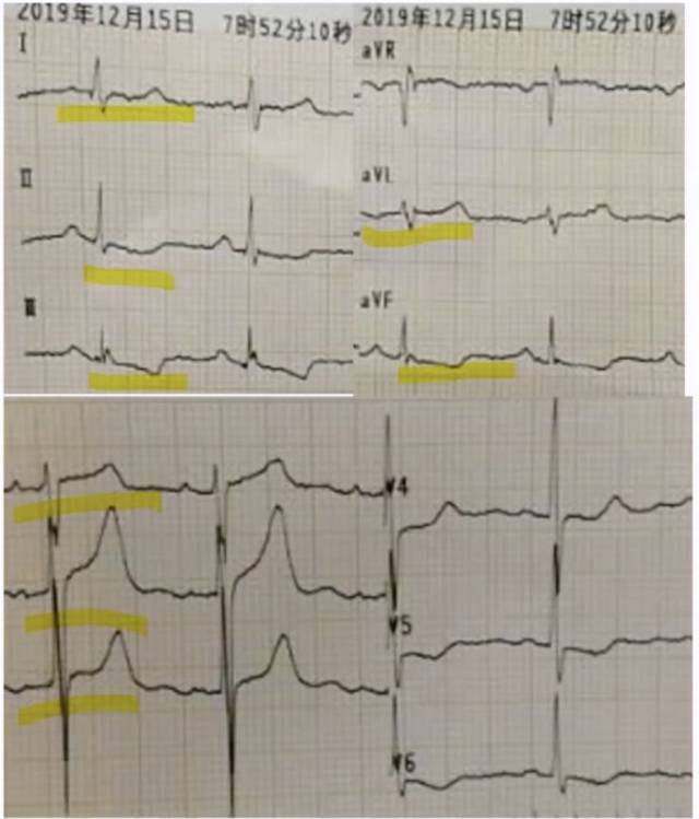 有症状: 胸闷 20 分钟,出汗 下壁 j 点抬高,iii 明显; 弓背向下 i,avl
